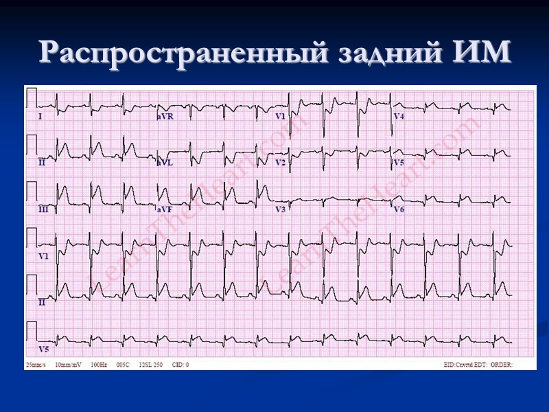 Распространенный задний ИМ